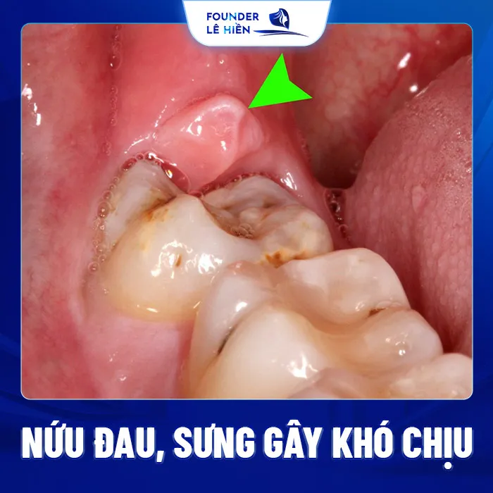 Cắt Lợi Trùm Cho Răng Khôn