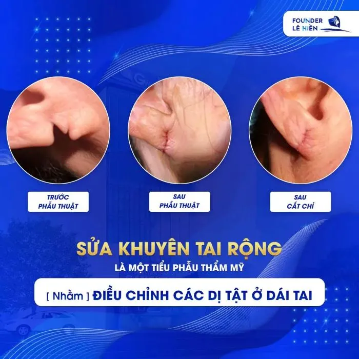 Sửa khuyên tai rộng