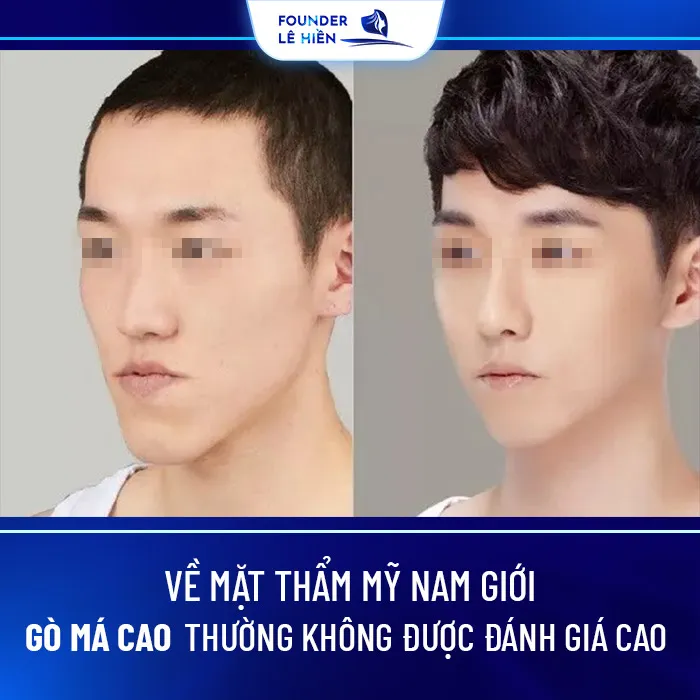 Hạ Gò Má Cho Nam Giới 