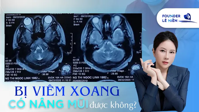 Bị Viêm Xoang Có Nâng Mũi Được Không