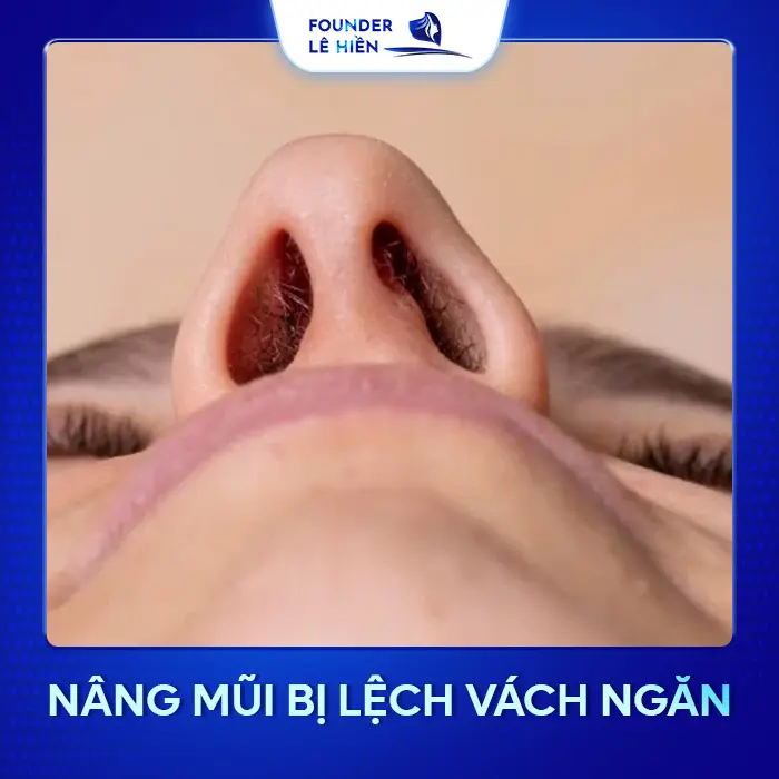 Nâng Mũi Bị Lệch Vách Ngăn