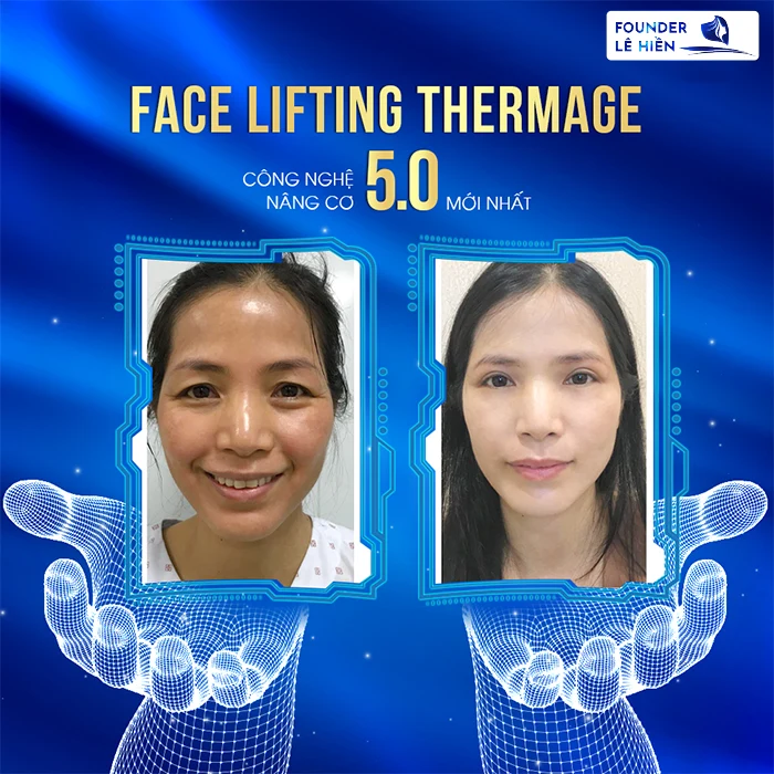 Các Phương Pháp Căng Da Mặt Chảy Xệ Theo Từng Cấp Độ - Face Lifting Thermage