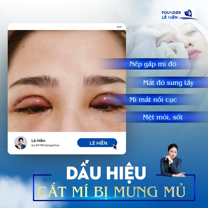 Cắt Mí Bị Mưng Mủ
