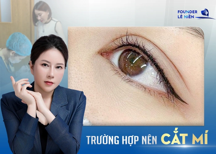 Cắt Mí Có Làm Mắt To Hơn Không?