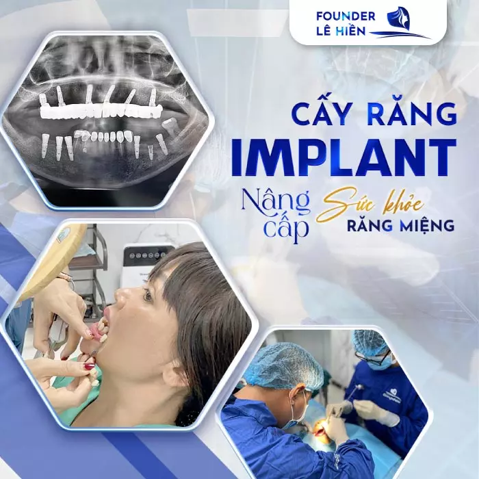 Cấy ghép Implant