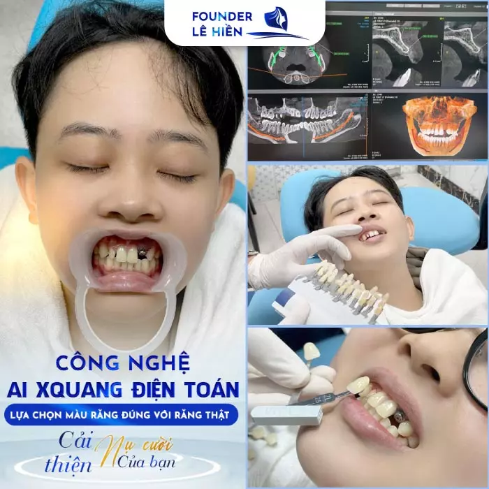 Cấy ghép Implant