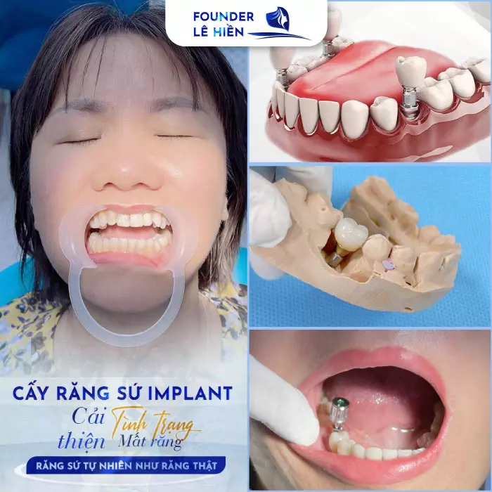 Cấy ghép Implant