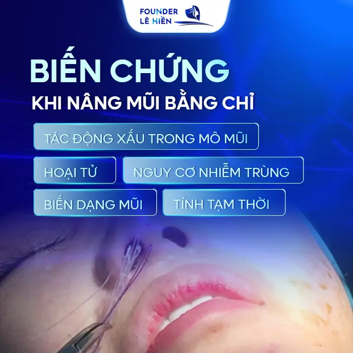 Biến Chứng Nâng Mũi Bằng Chỉ