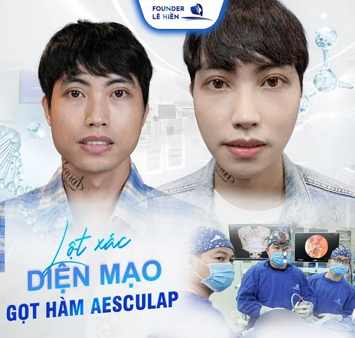 Quy trình thực hiện gọt hàm an toàn, chuẩn y khoa