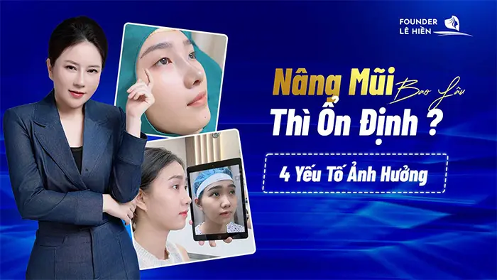 Nâng Mũi Bao Lâu Thì Ổn Định