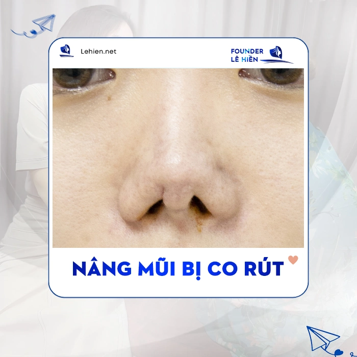 Nâng Mũi Bị Co Rút