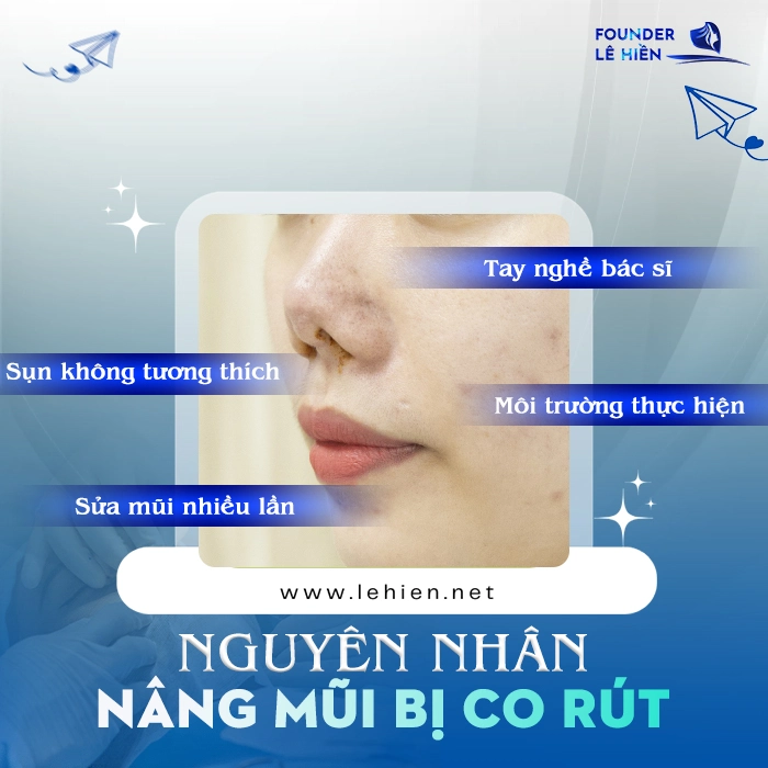 Nâng Mũi Bị Co Rút