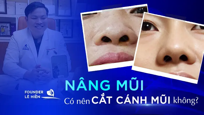 Nâng Mũi Có Nên Cắt Cánh Mũi Không