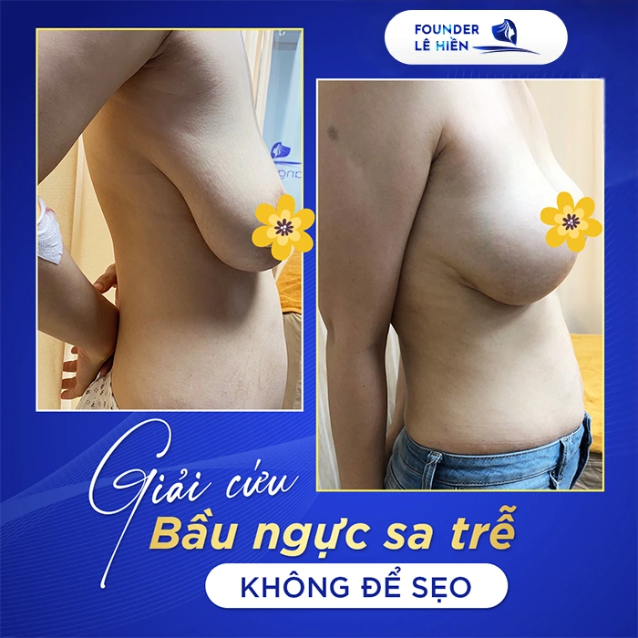 Sẹo Sau Treo Ngực Sa Trễ Có Hết Hoàn Toàn Không?