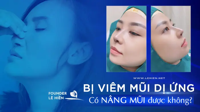 Bị Viêm Mũi Dị Ứng Có Nâng Mũi Được Không