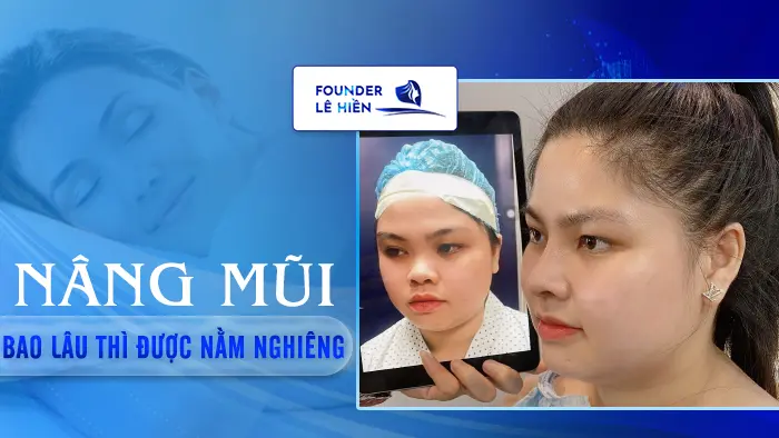 Nâng Mũi Bao Lâu Thì Được Nằm Nghiêng