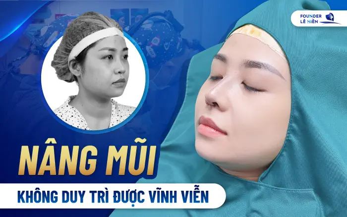 Nâng Mũi Có Được Vĩnh Viễn Không