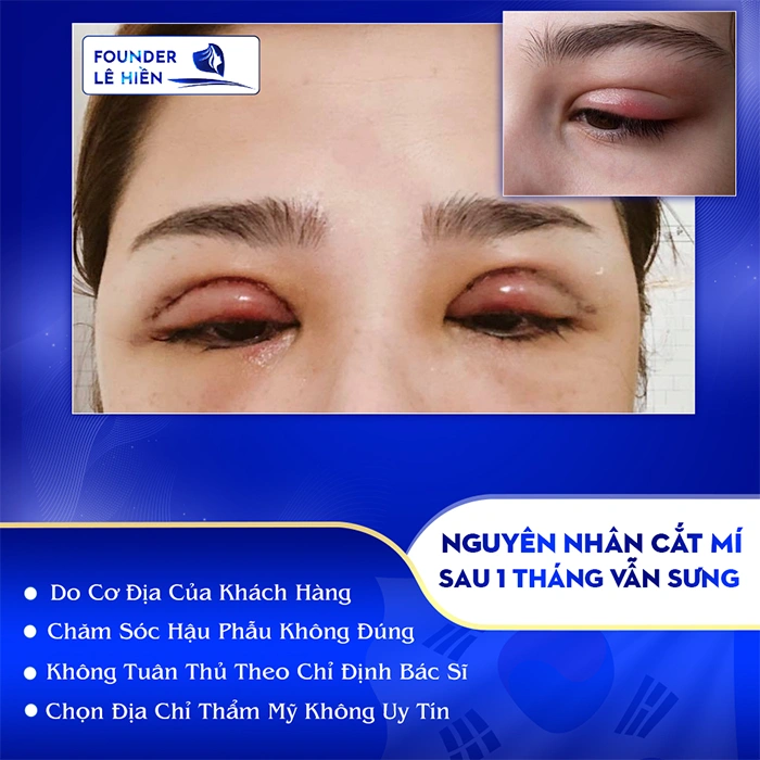 Nguyên Nhân Cắt Mí Sau 1 Tháng Vẫn Sưng