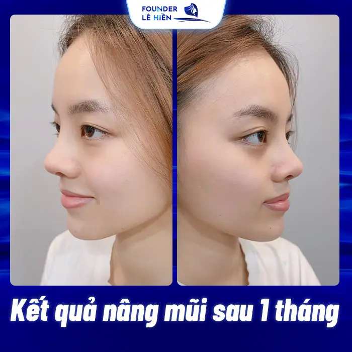 Nâng Mũi Chỉ Xoắn Kép Là Gì