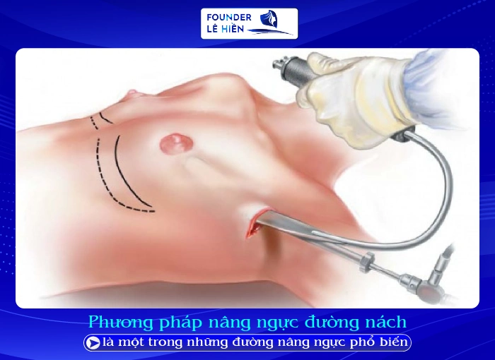 Nâng Ngực Đường Nách