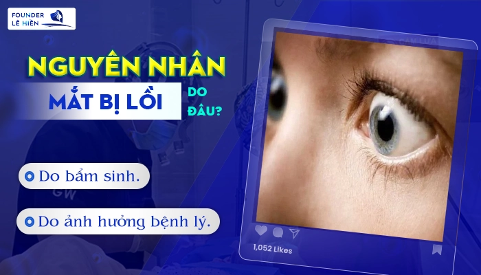 Nguyên Nhân Dẫn Đến Tình Trạng Mắt Lồi