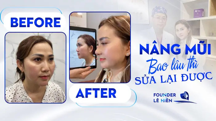 nang mui bao lau thi sua lai duoc