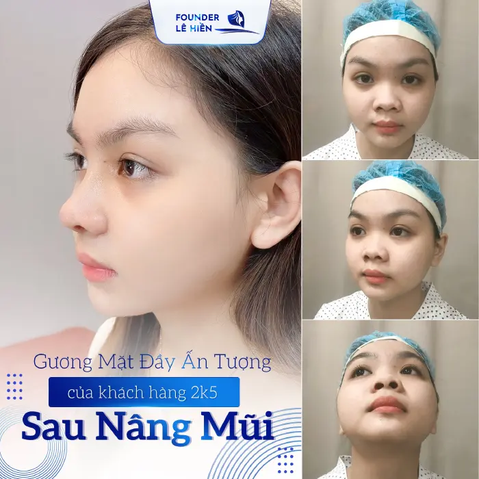 Nâng Mũi Mất Bao Nhiêu Thời Gian