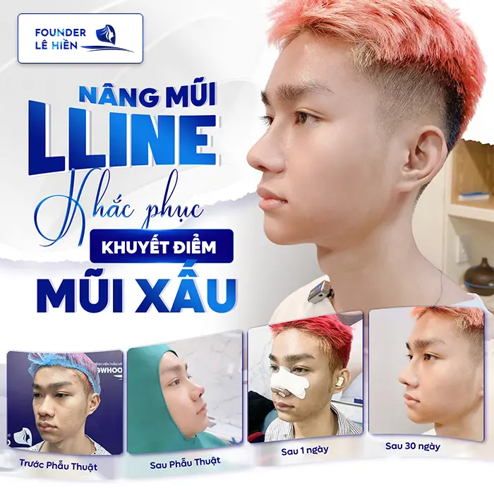 Nâng Mũi L Line Hay S Line Đẹp