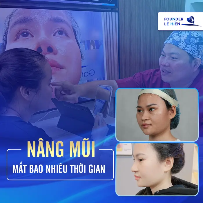 Nâng Mũi Mất Bao Nhiêu Thời Gian