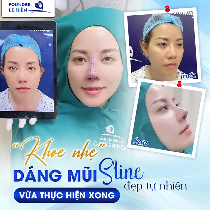 Nâng Mũi L Line Hay S Line Đẹp