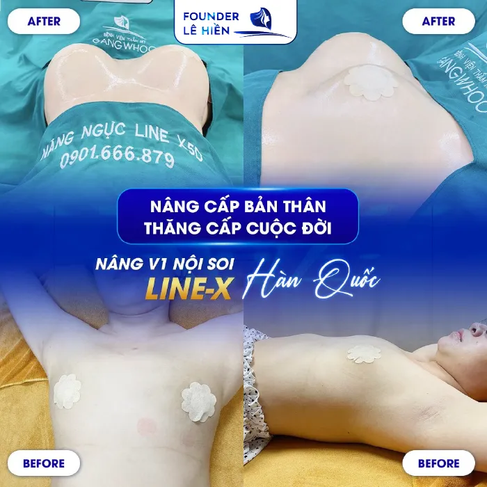 Nâng Ngực Đường Nách 