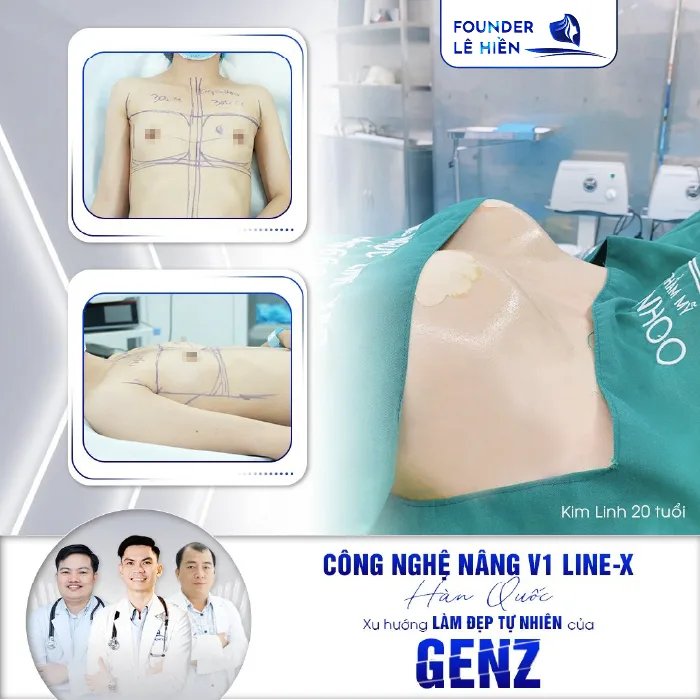 Nâng Ngực Đường Chân Ngực