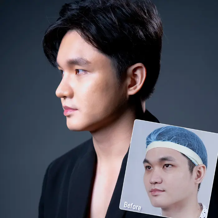 Nâng Mũi Có Thay Đổi Khuôn Mặt Không