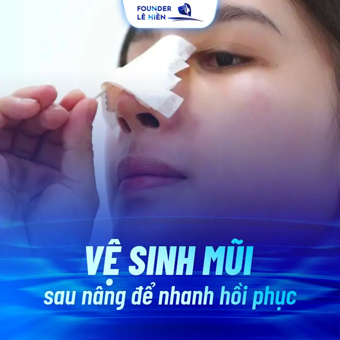 Nâng Mũi Bao Lâu Thì Hết Dịch