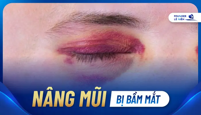 Nâng Mũi Bị Bầm Mắt 