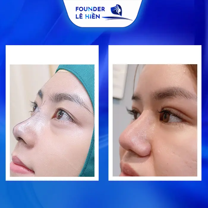 Có Nên Nâng Mũi Và Cắt Mí Mắt Cùng Lúc