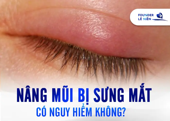 Nâng Mũi Bị Sưng Mắt Do Đâu