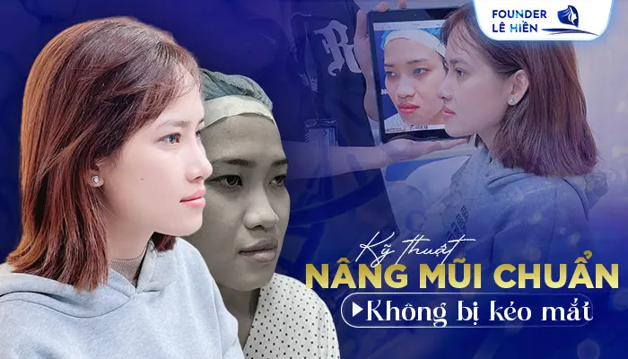 Nâng Mũi Bị Kéo Mắt Phải Làm Sao