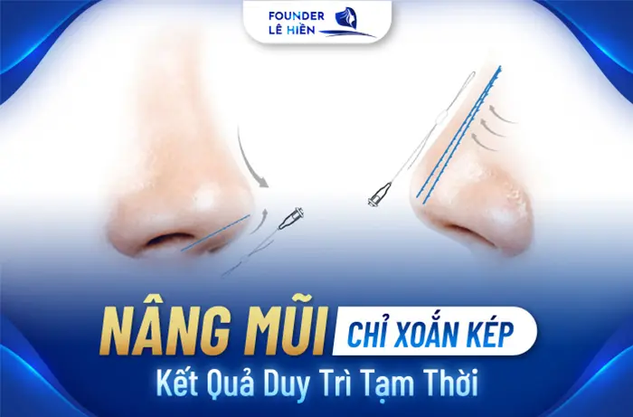 Nâng Mũi Chỉ Xoắn Kép Là Gì