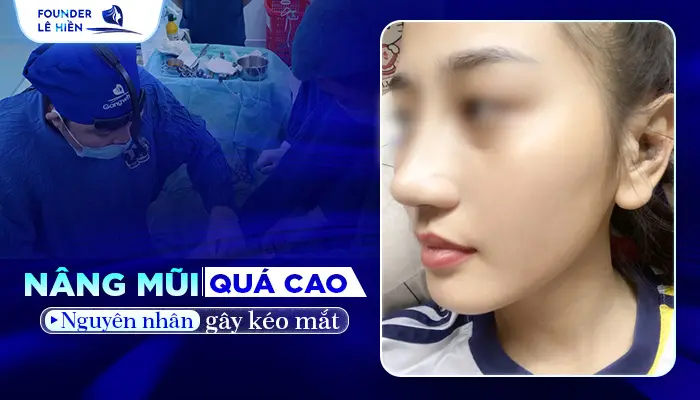 Nâng Mũi Bị Kéo Mắt Phải Làm Sao