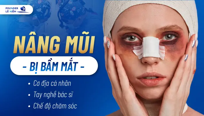 Nâng Mũi Bị Bầm Mắt 