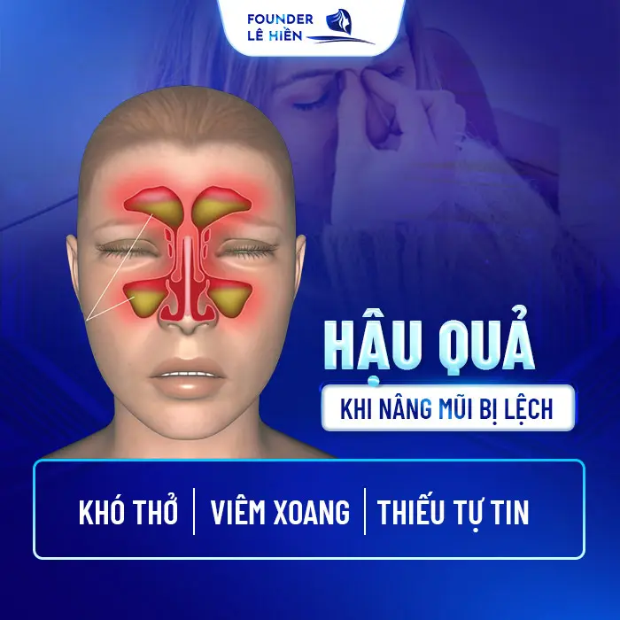 Nâng Mũi Bị Lệch