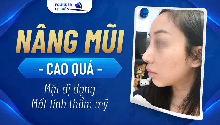 Có Nên Nâng Mũi Cao