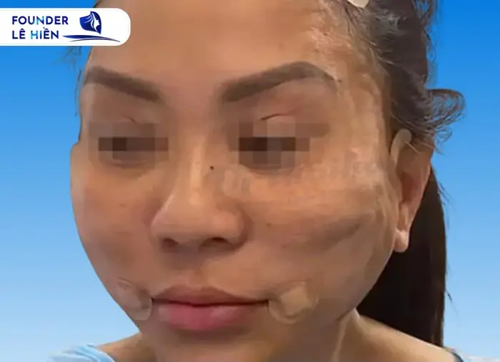 Căng chỉ collagen có thể gây tác dụng phụ nếu thực hiện tại cơ sở không uy tín