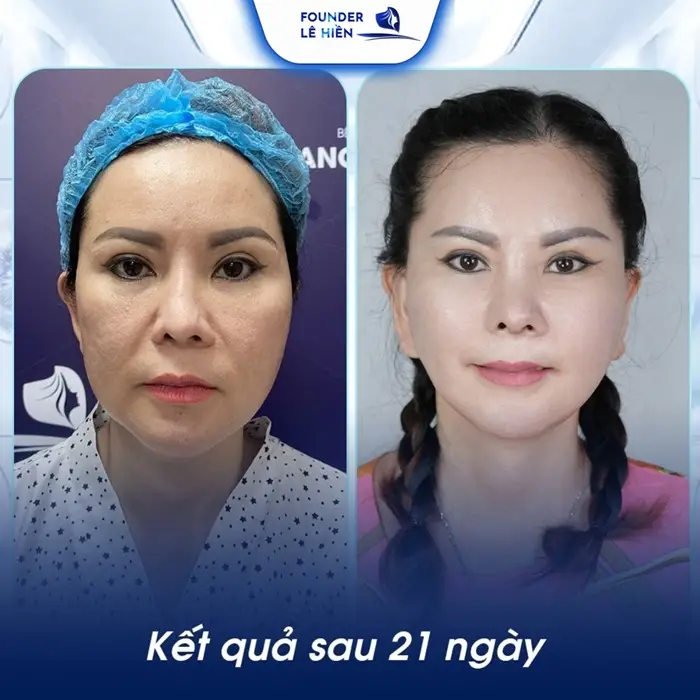 Mức độ lão hóa của da ảnh hưởng đến chi phí căng da mặt