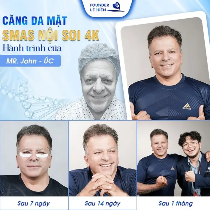 Chi phí căng da tùy vào công nghệ được sử dụng