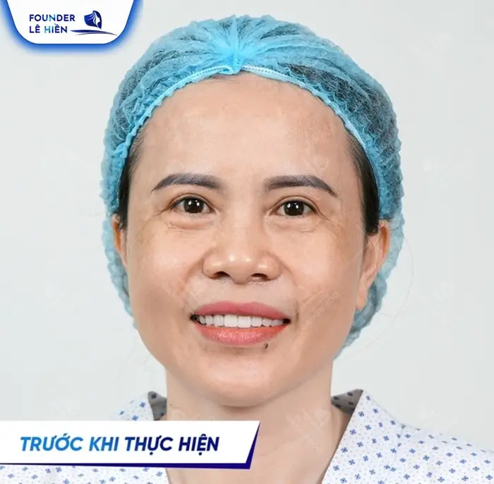 Đối tượng nên căng da mặt bằng chỉ