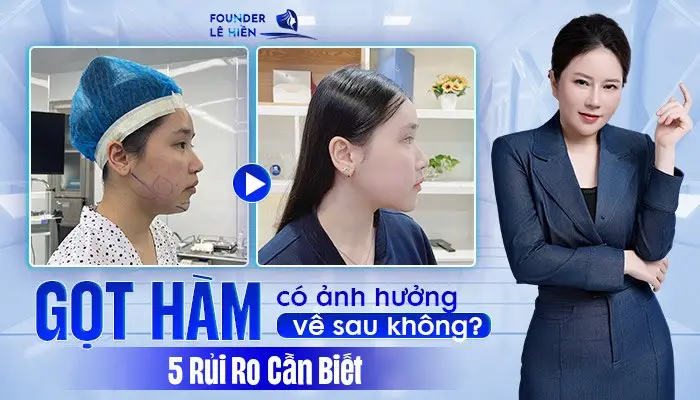 Gọt Hàm Có Ảnh Hưởng Về Sau Không? 5 Rủi Ro Cần Biết