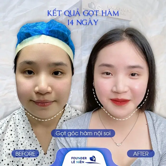 Kết quả gọt hàm tại Bệnh viện thẩm mỹ của Founder Lê Hiền