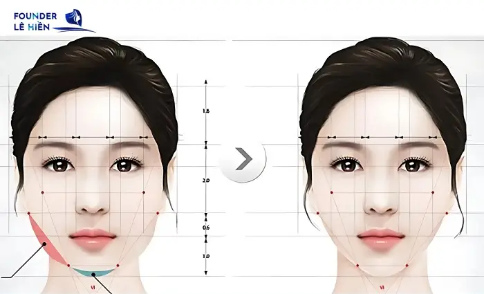Phẫu Thuật Gọt Hàm Sau Bao Lâu Thì Hết Tê? 2 Nguyên nhân gây tê sau phẫu thuật gọt hàm